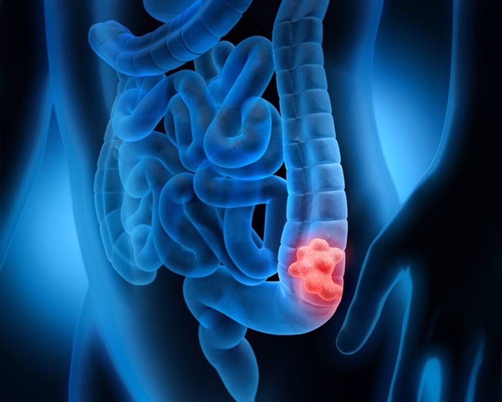 Cáncer de colon y recto: síntomas, prevención y tratamiento oportuno